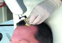 Terapie łysienia androgenowego Karboksyterapia